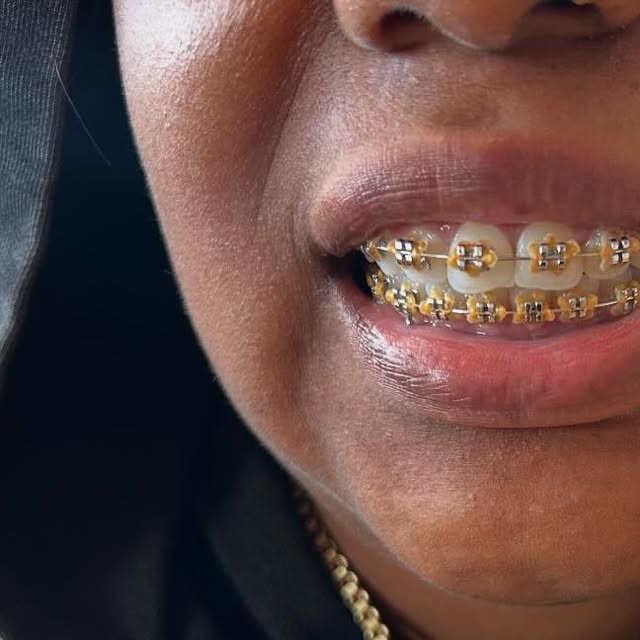 Gold braces close-up