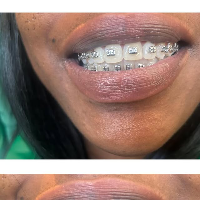 Silver braces before and after