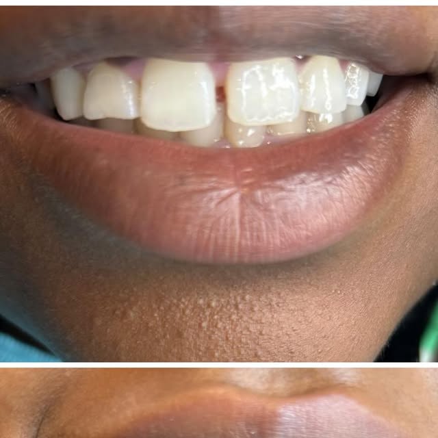 Before and after smile transformation