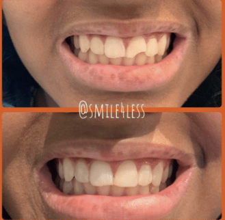 Before and after whitening