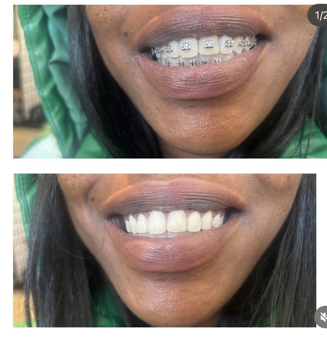 Smile4Less LA patient result