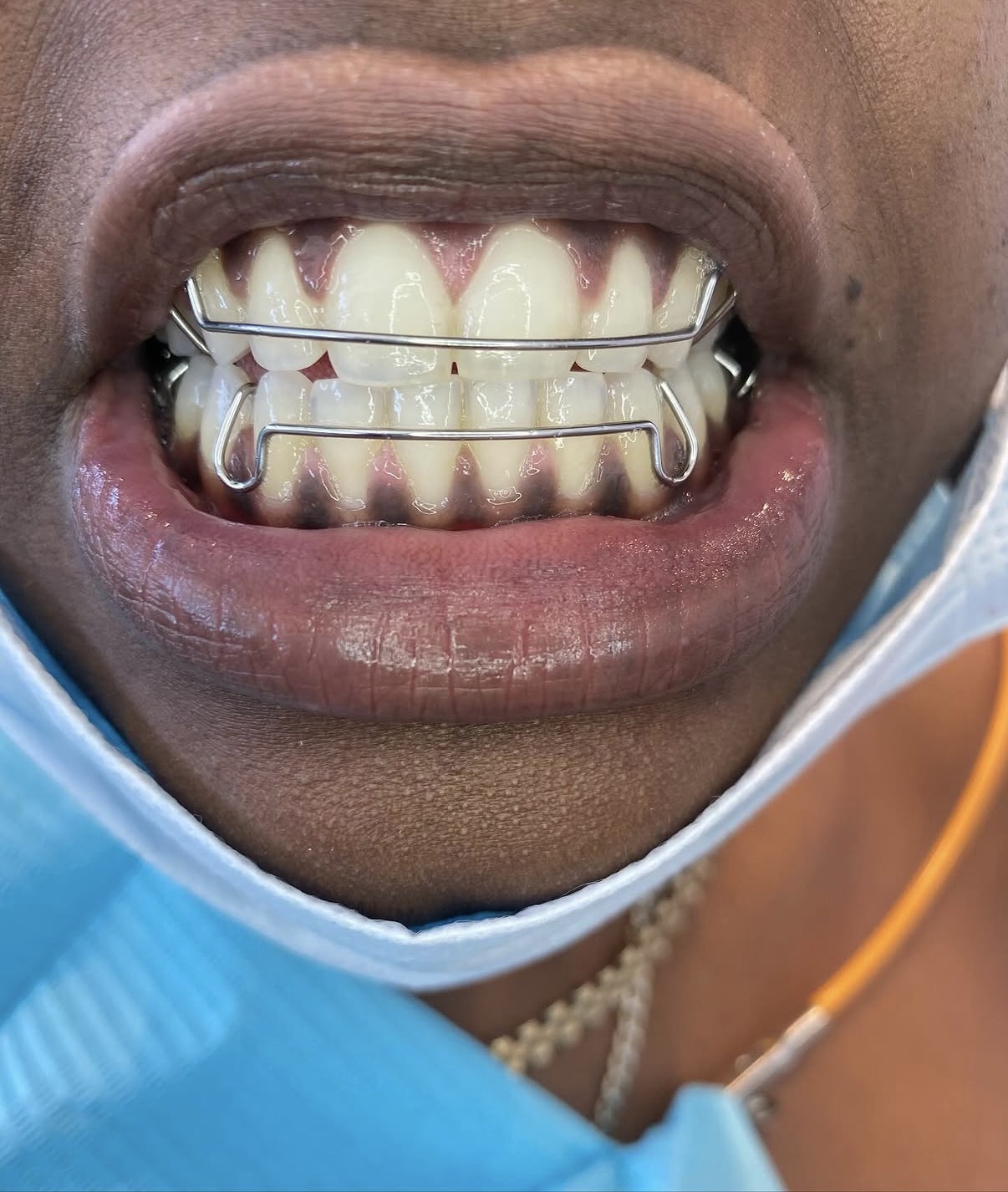 Cosmetic dental procedure result