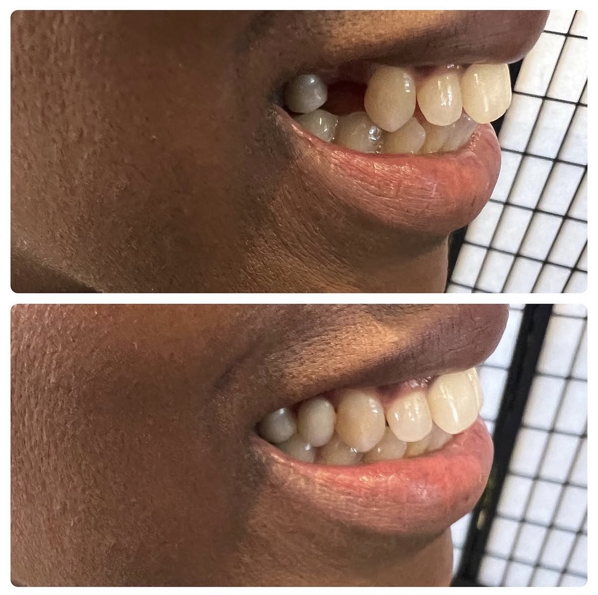 Smile4Less LA cosmetic result